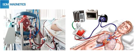 centrifugal ecmo pump|ecmo indications and contraindications.